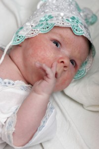 赤ちゃん湿疹-1