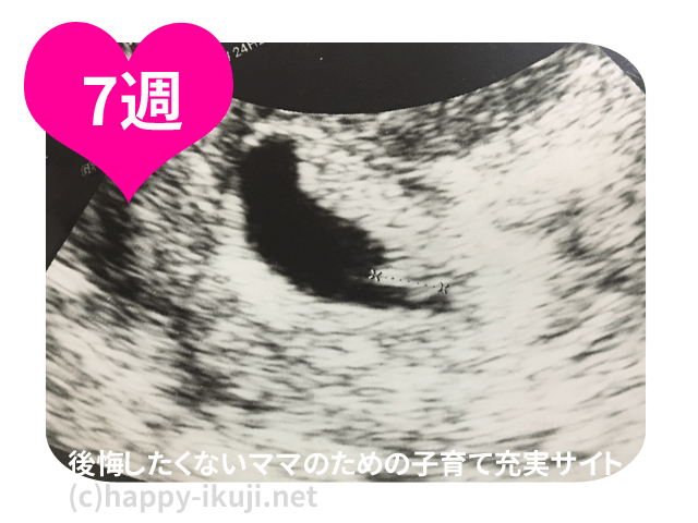妊娠7週目のお腹と赤ちゃんのエコー写真！100人に聞いた妊婦検診で注意されたこと